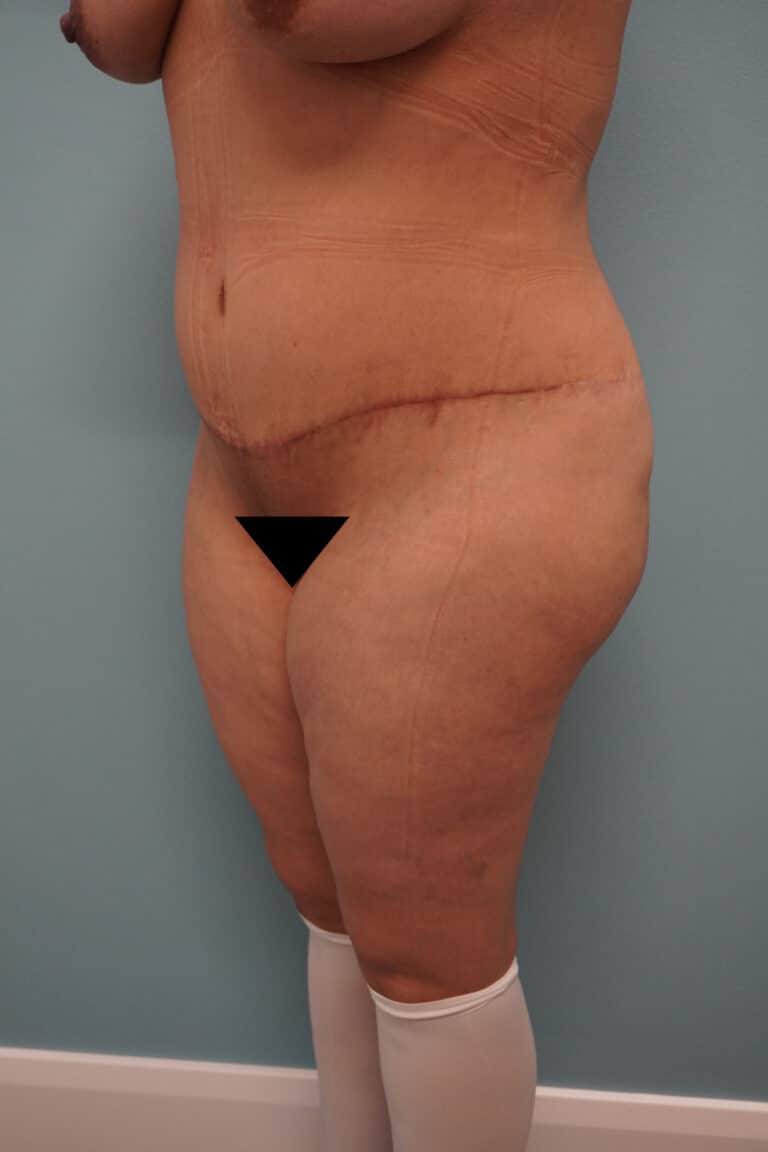 After Image: Tummy Tuck - left-front-oblique