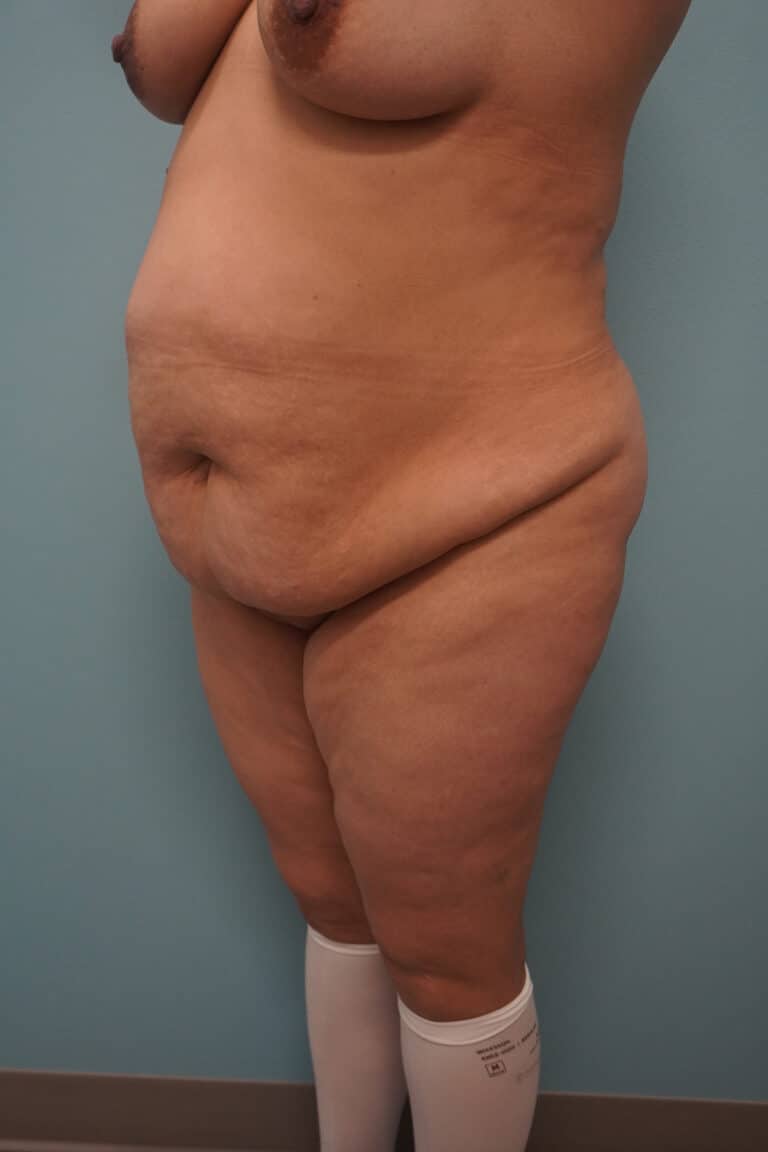 Before Image: Tummy Tuck - left-front-oblique