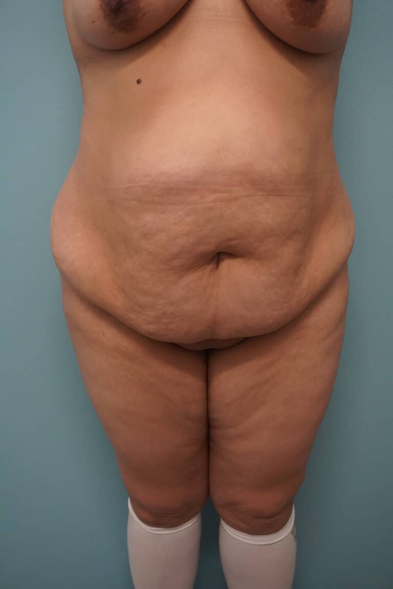 Before Image: Tummy Tuck - front