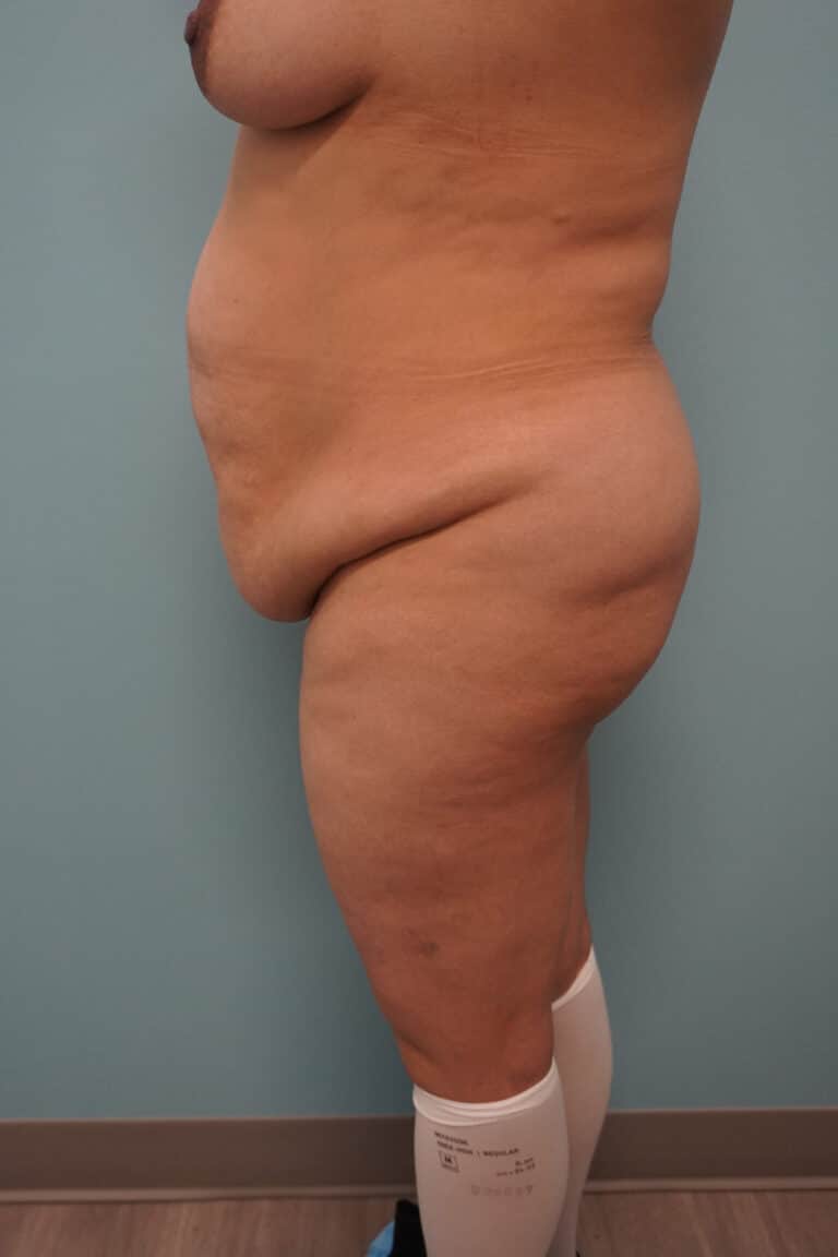 Before Image: Tummy Tuck - left-side
