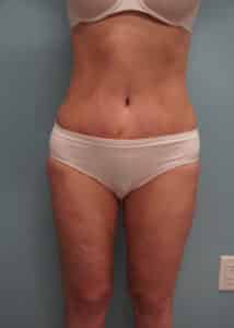 After Image: Tummy Tuck