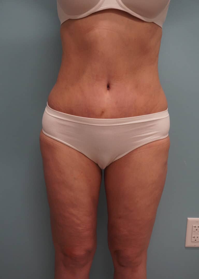 After Image: Tummy Tuck - front