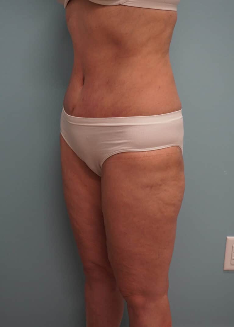 After Image: Tummy Tuck - left-front-oblique