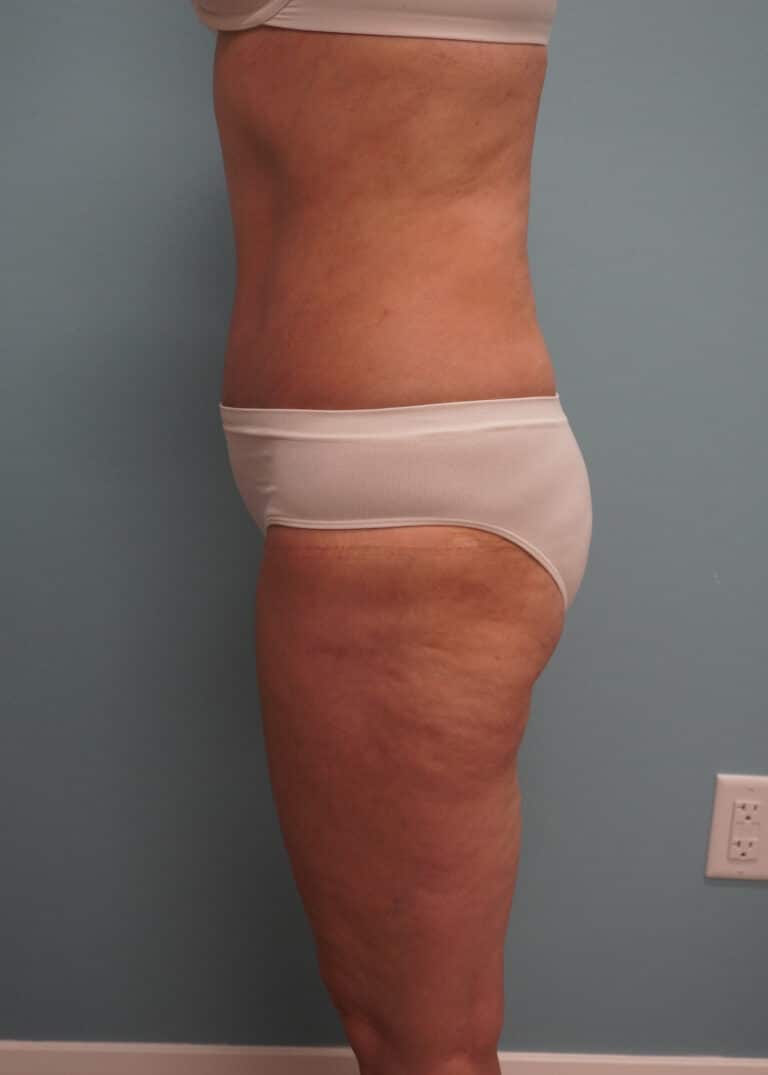 After Image: Tummy Tuck - left-side