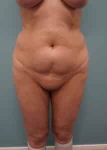 Before Image: Tummy Tuck