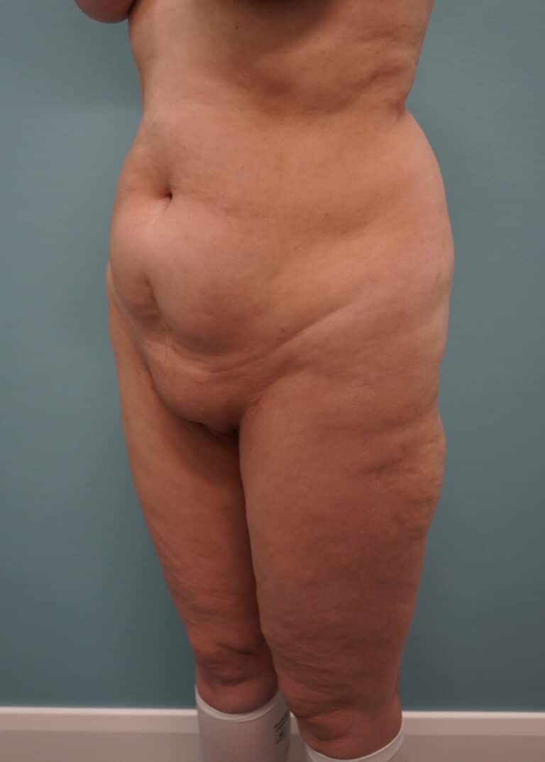 Before Image: Tummy Tuck - left-front-oblique