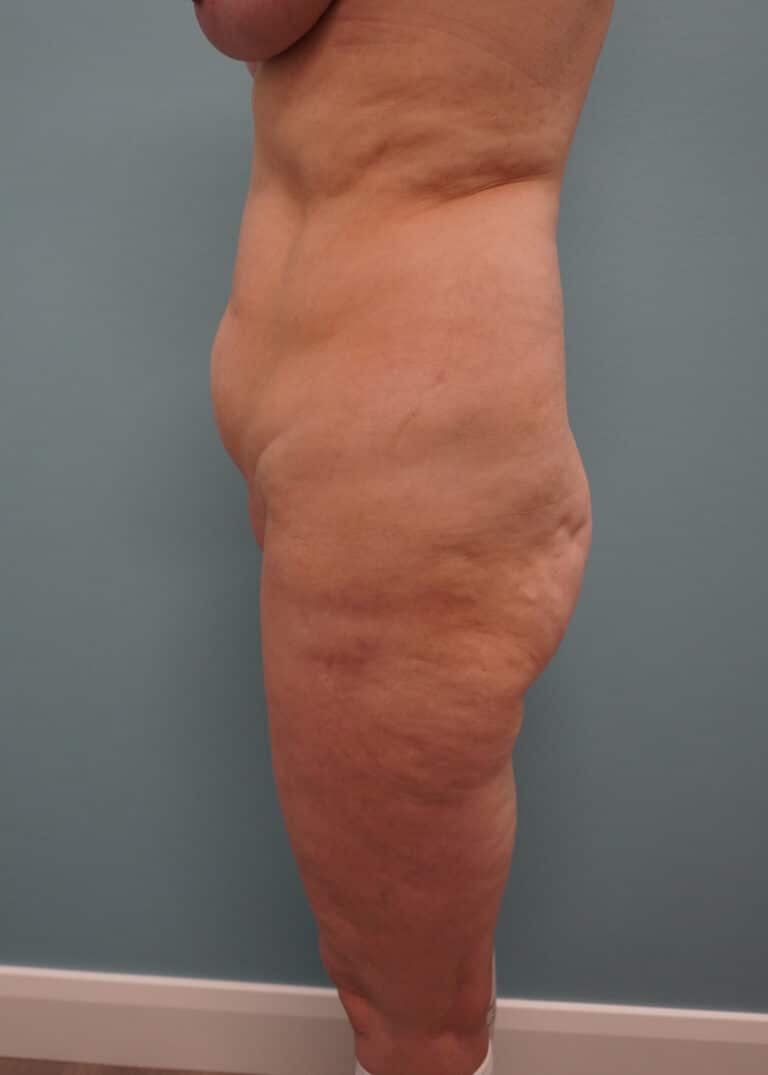 Before Image: Tummy Tuck - left-side