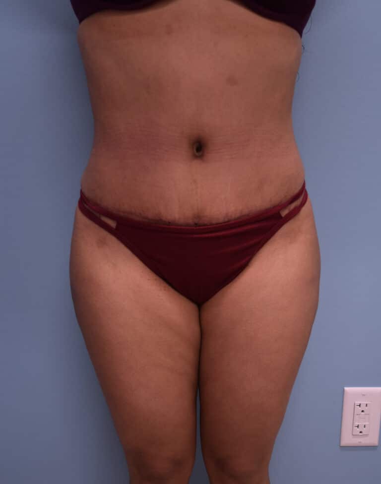 After Image: Tummy Tuck - front