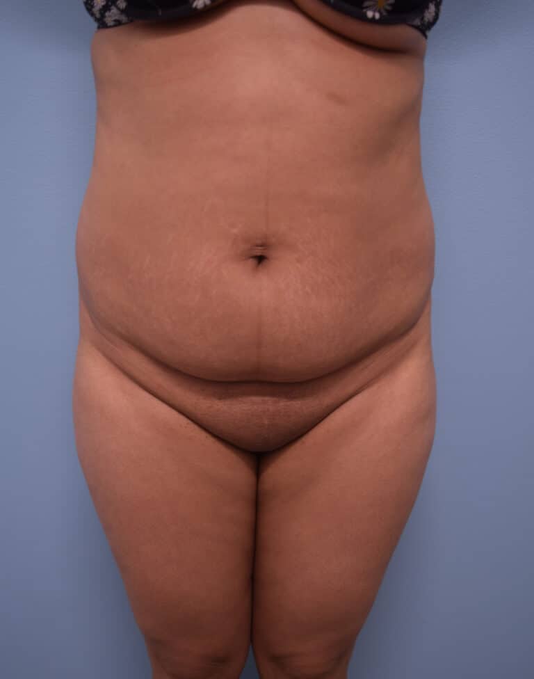 Before Image: Tummy Tuck - front