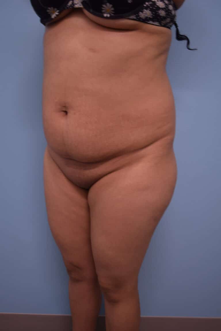 Before Image: Tummy Tuck - left-front-oblique