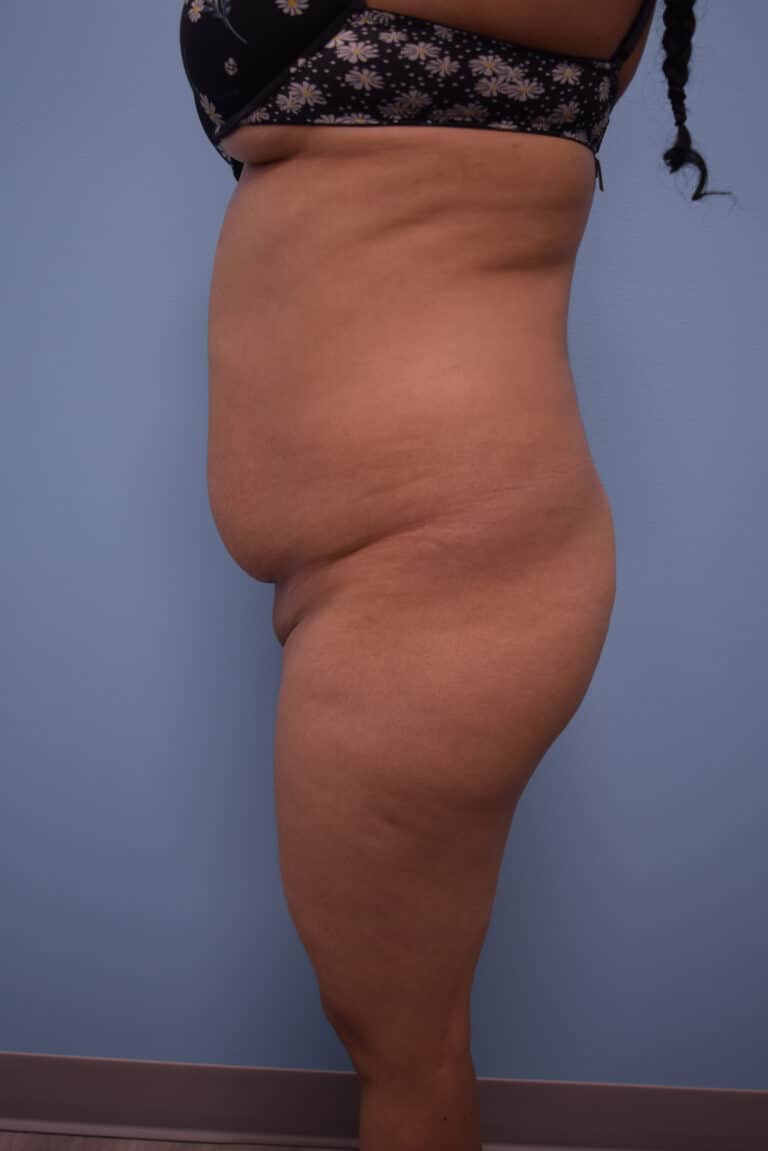 Before Image: Tummy Tuck - left-side