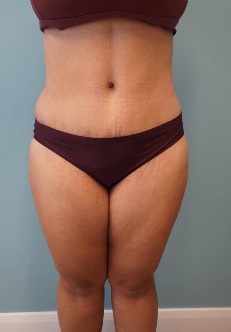 After Image: Tummy Tuck - front