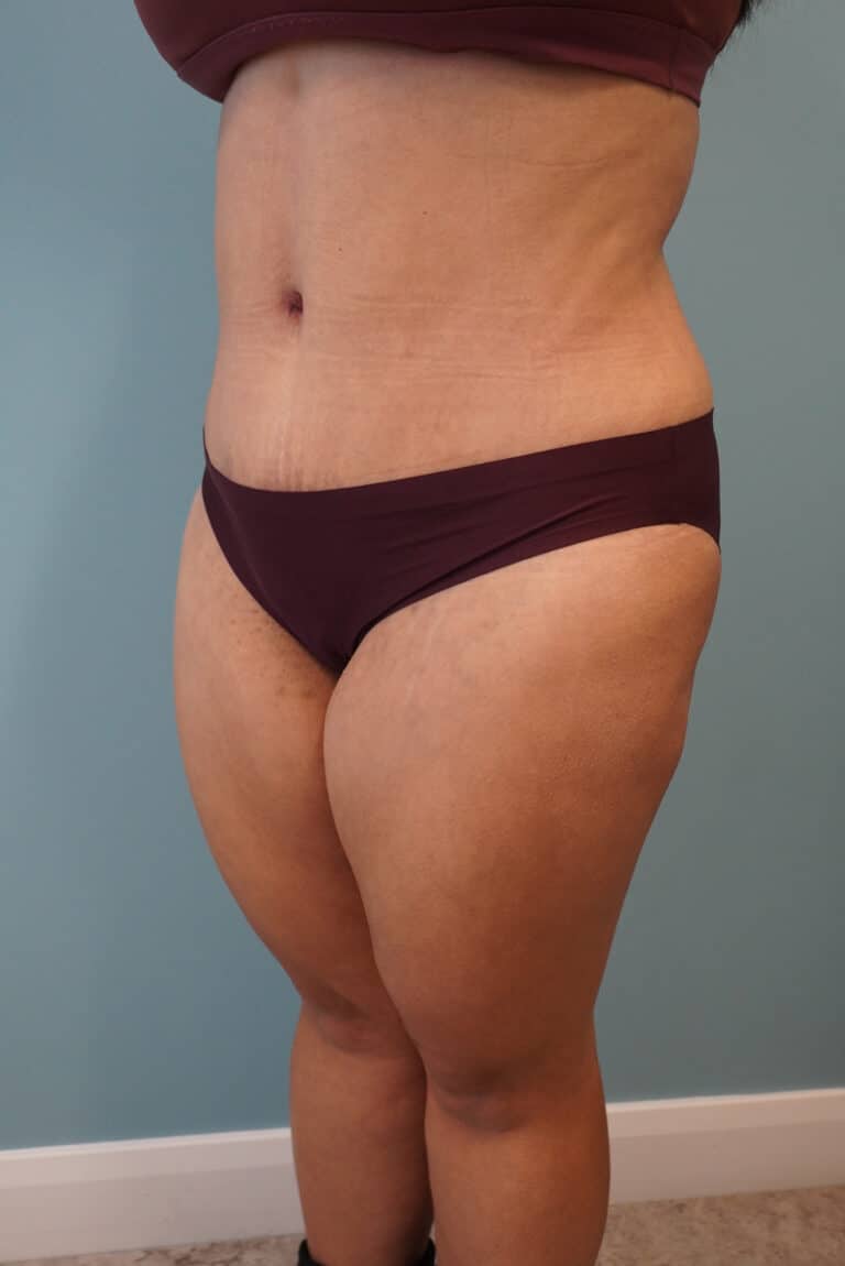 After Image: Tummy Tuck - left-front-oblique