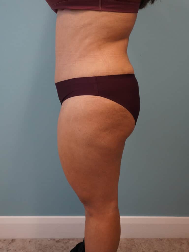 After Image: Tummy Tuck - left-side