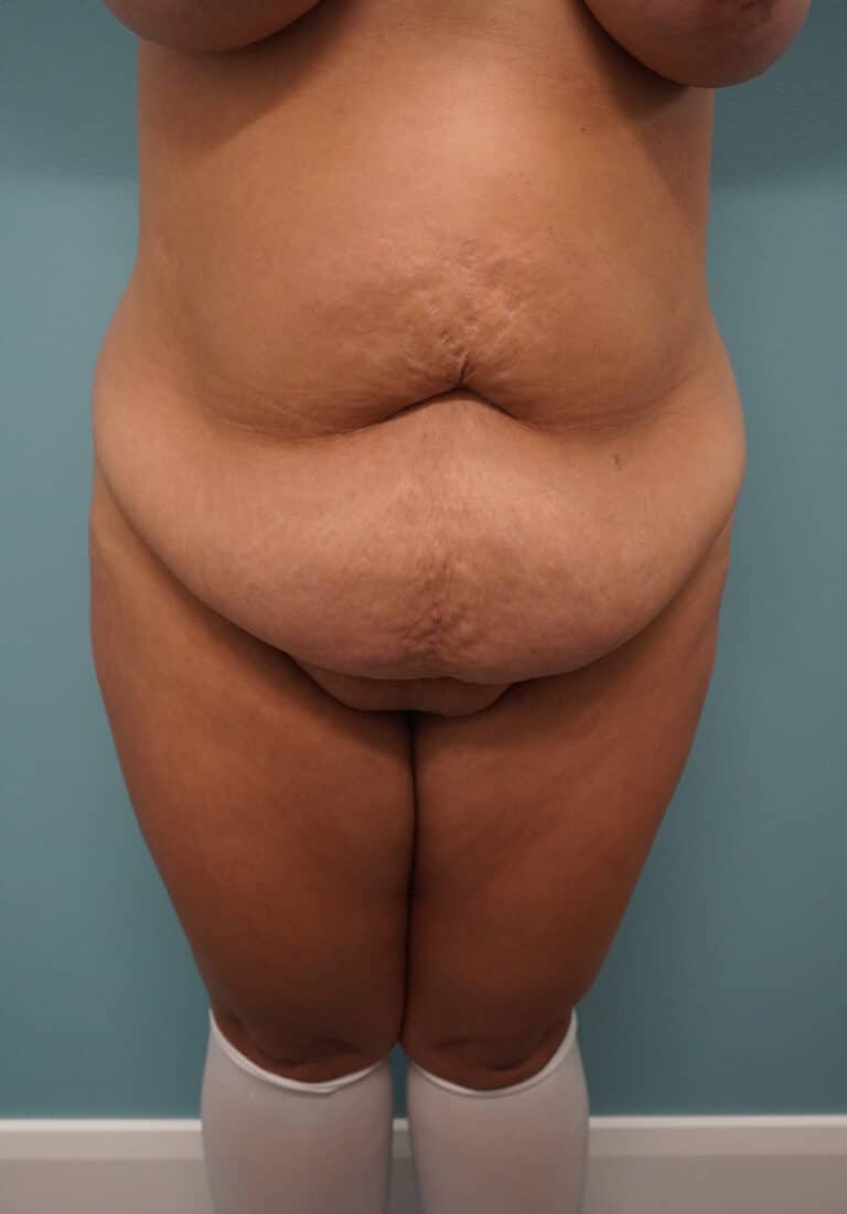 Before Image: Tummy Tuck - front