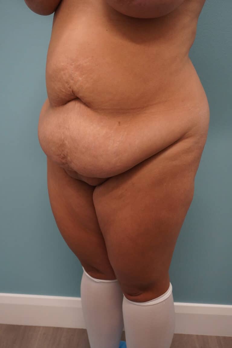 Before Image: Tummy Tuck - left-front-oblique