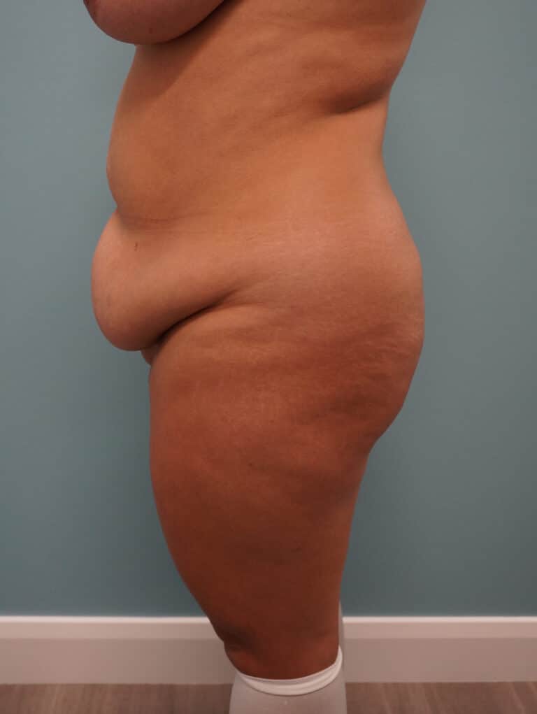 Before Image: Tummy Tuck - left-side