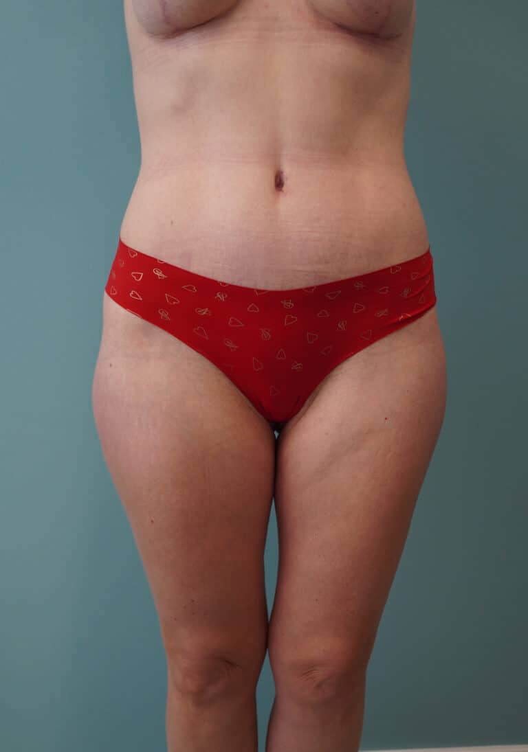 After Image: Tummy Tuck - front