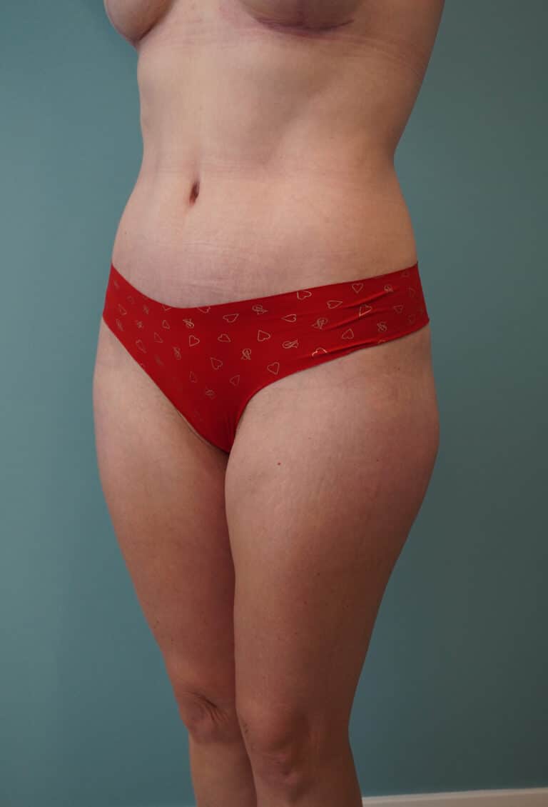 After Image: Tummy Tuck - left-front-oblique