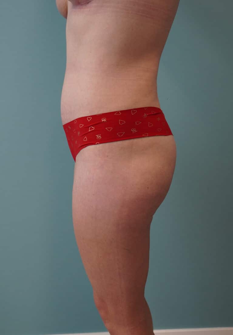 After Image: Tummy Tuck - left-side