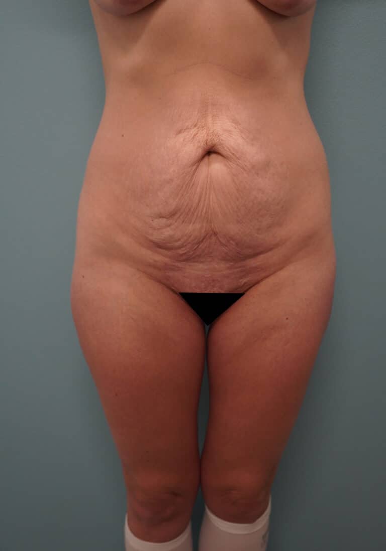 Before Image: Tummy Tuck - front