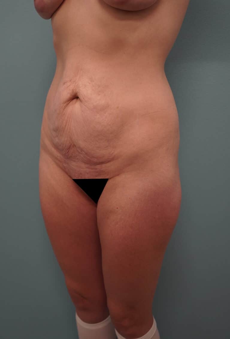 Before Image: Tummy Tuck - left-front-oblique