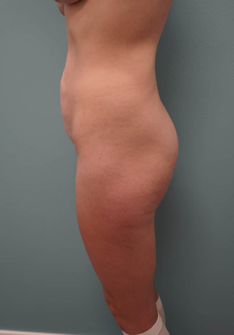 Before Image: Tummy Tuck - left-side
