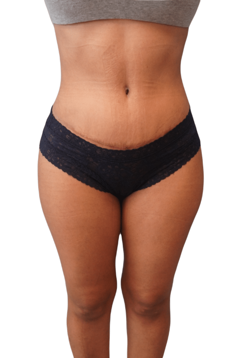 After Image: Tummy Tuck - front