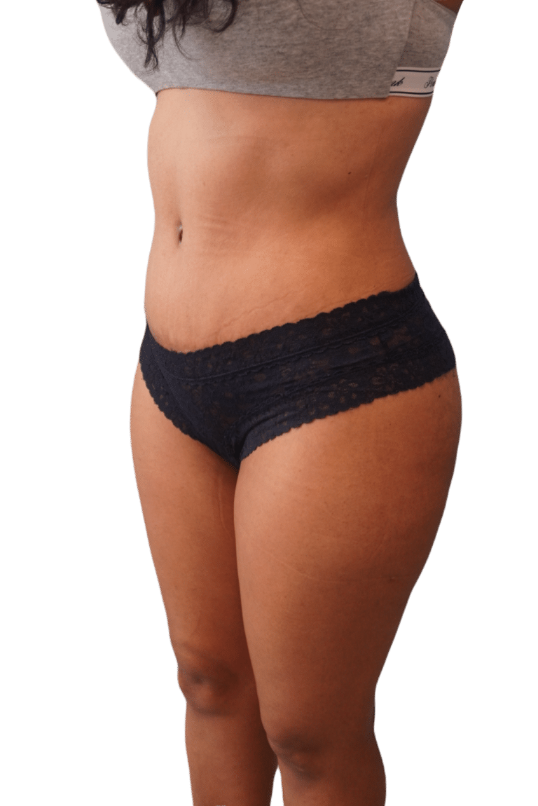 After Image: Tummy Tuck - left-front-oblique