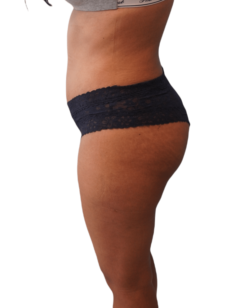 After Image: Tummy Tuck - left-side