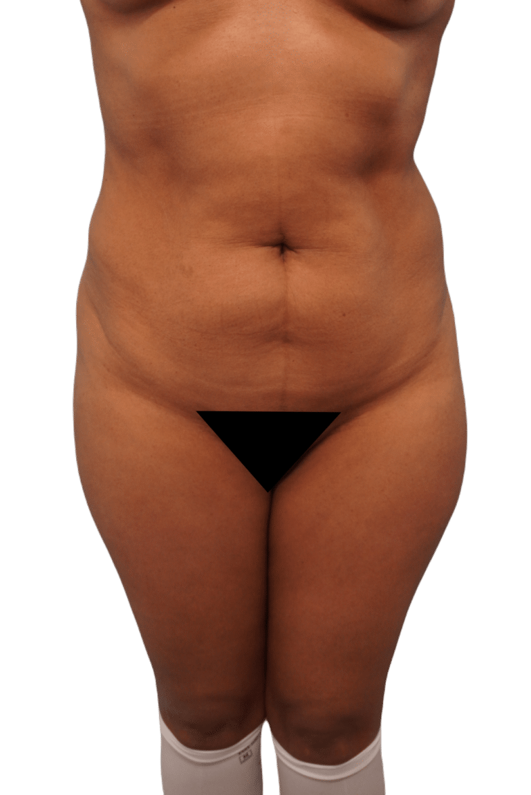 Before Image: Tummy Tuck - front