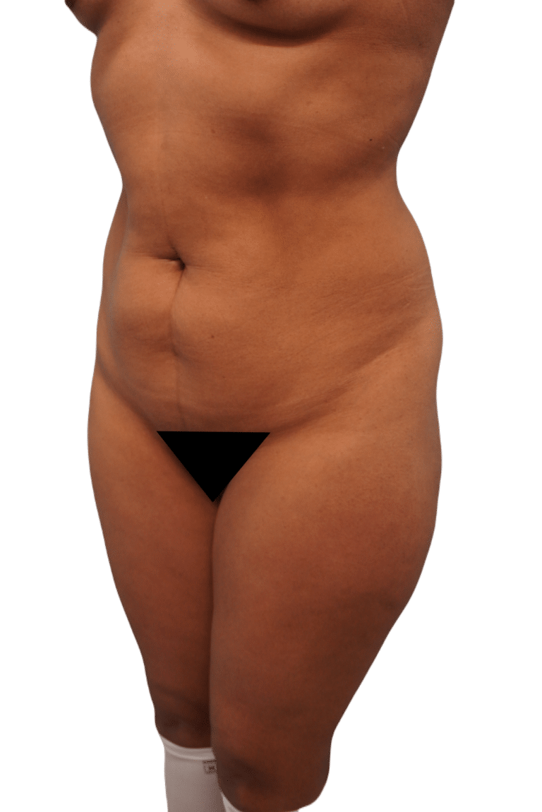 Before Image: Tummy Tuck - left-front-oblique