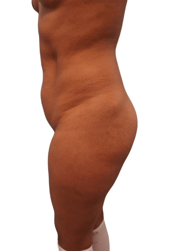 Before Image: Tummy Tuck - left-side