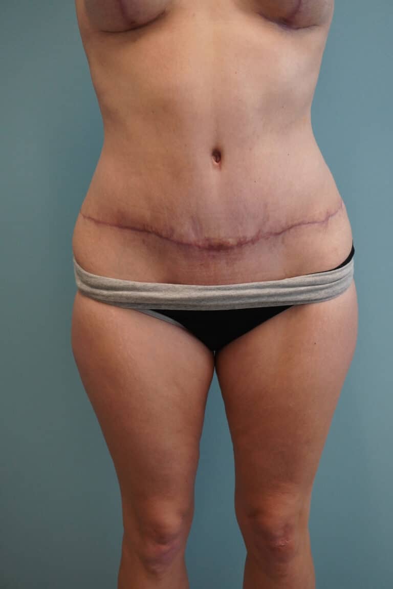 After Image: Tummy Tuck - front