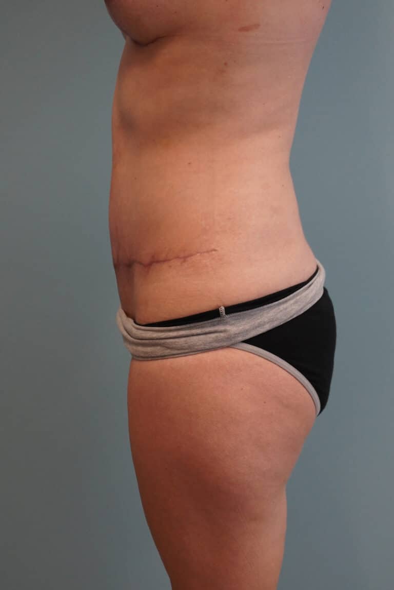 After Image: Tummy Tuck - left-side