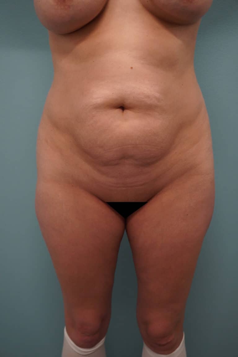 Before Image: Tummy Tuck - front