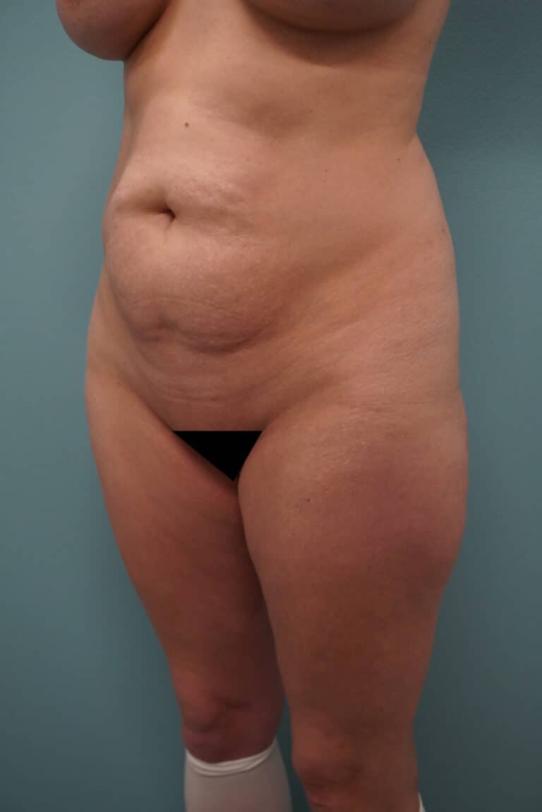 Before Image: Tummy Tuck - left-front-oblique