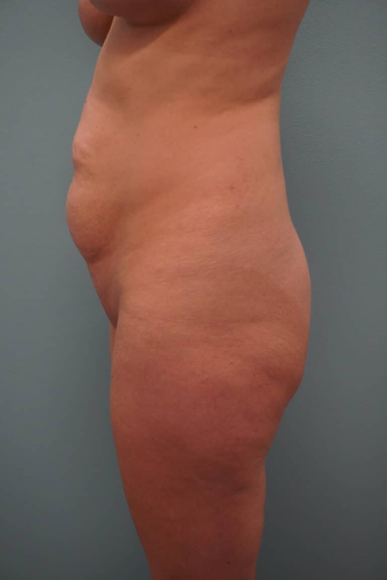 Before Image: Tummy Tuck - left-side