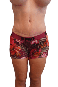 After Image: Tummy Tuck