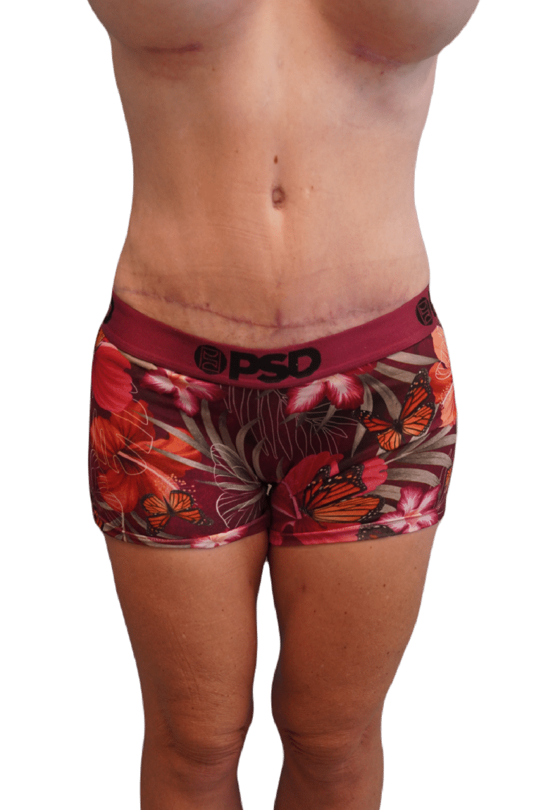 After Image: Tummy Tuck - front