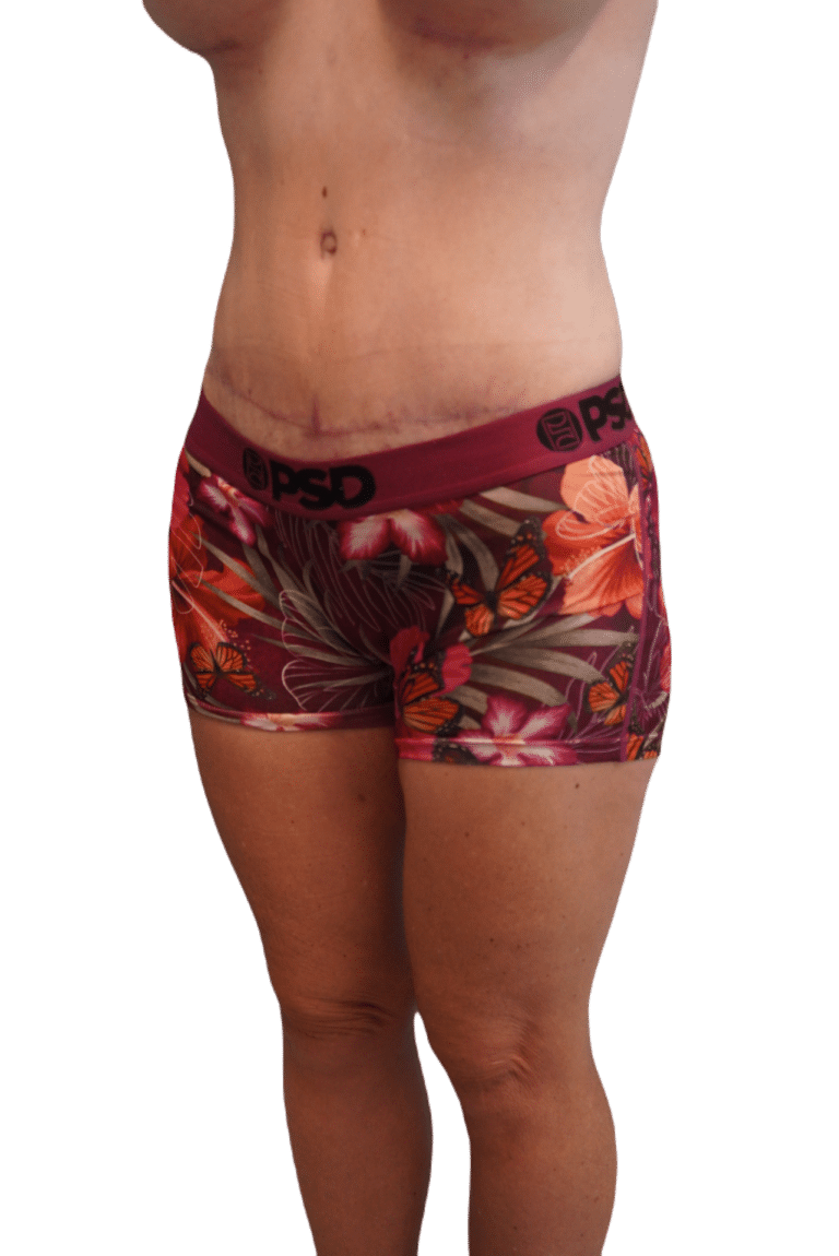 After Image: Tummy Tuck - left-front-oblique