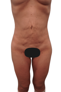 Before Image: Tummy Tuck