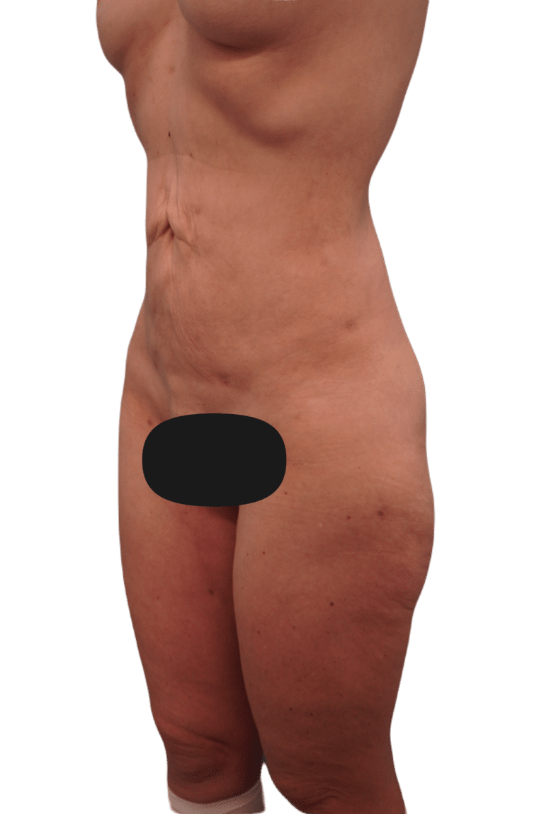 Before Image: Tummy Tuck - left-front-oblique