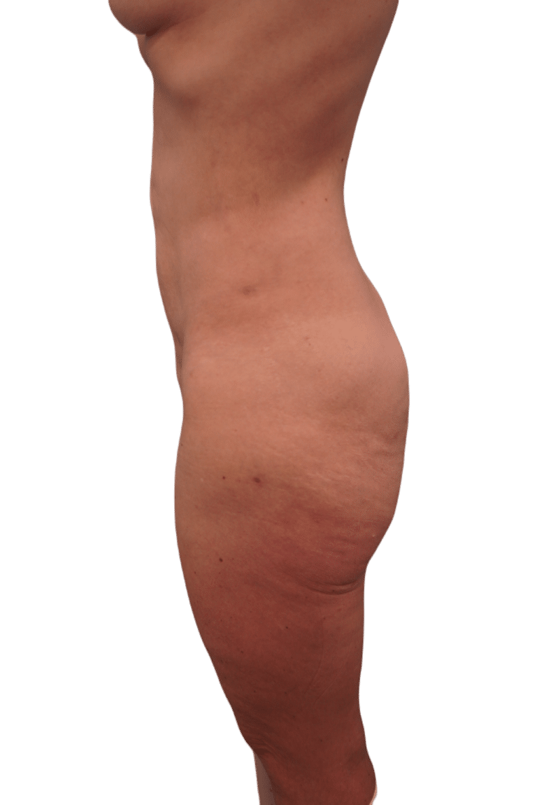 Before Image: Tummy Tuck - left-side