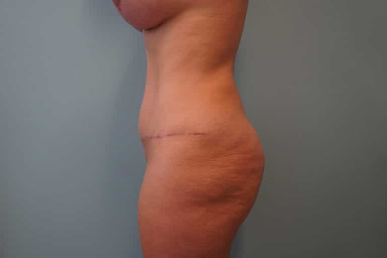 After Image: Tummy Tuck - left-side