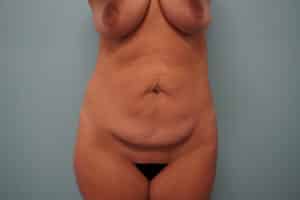 Before Image: Tummy Tuck
