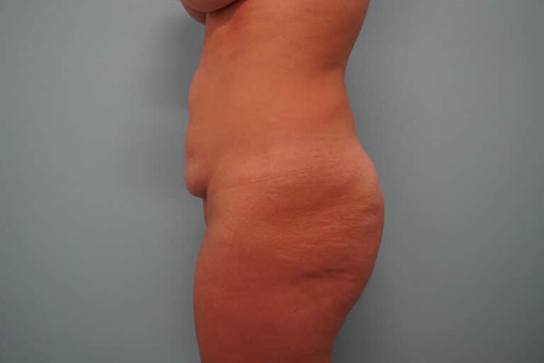 Before Image: Tummy Tuck - left-side