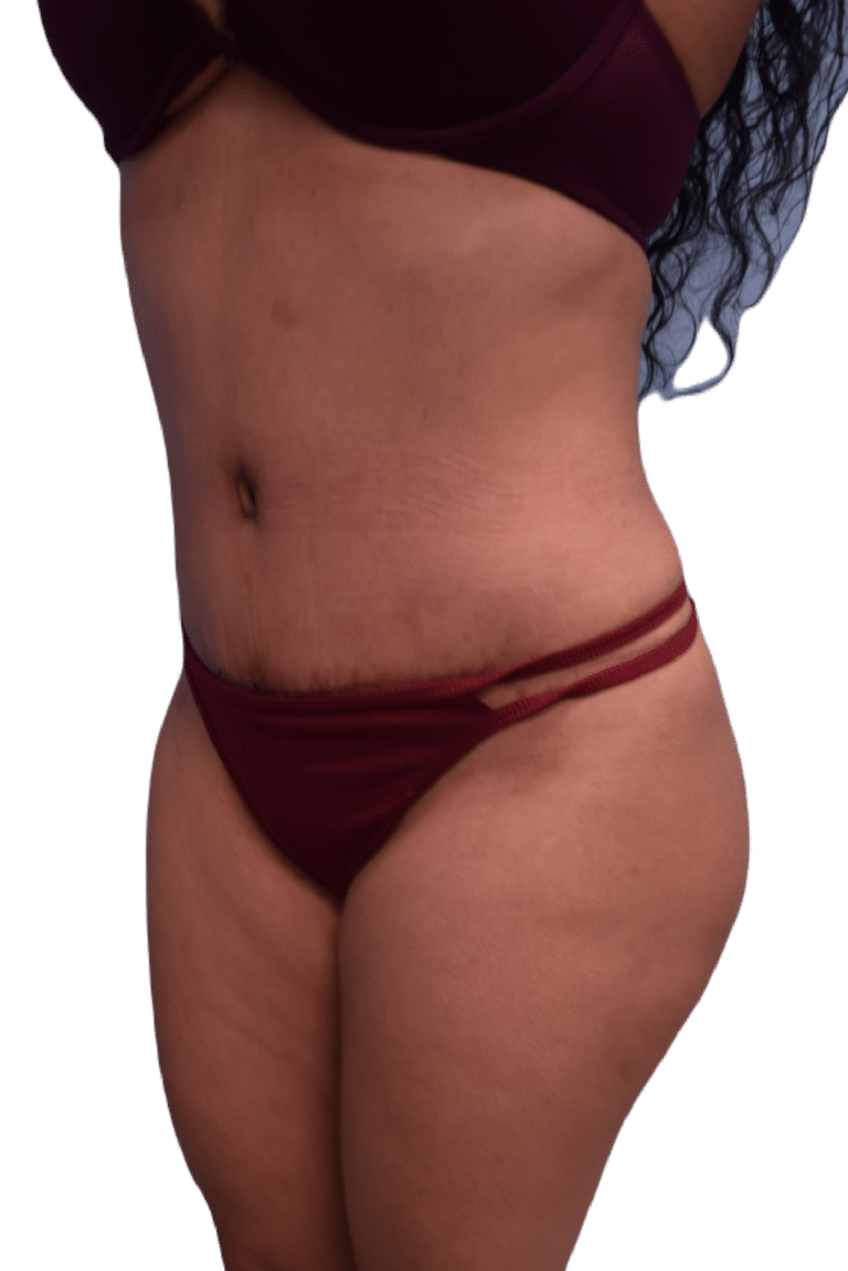 After Image: Tummy Tuck - left-front-oblique
