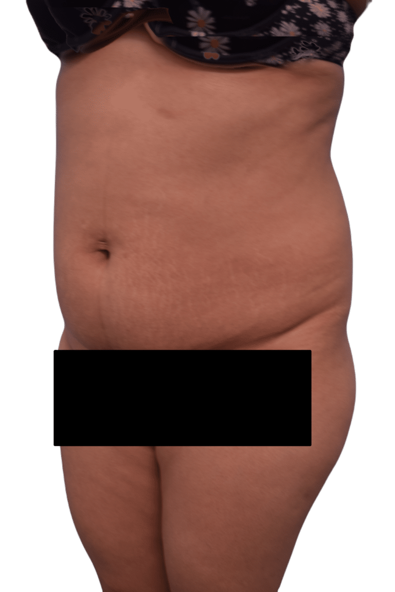Before Image: Tummy Tuck - left-front-oblique