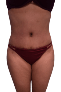 After Image: Tummy Tuck